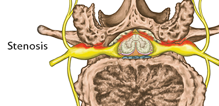 cervical-spinal-stenosis-condition-illustration