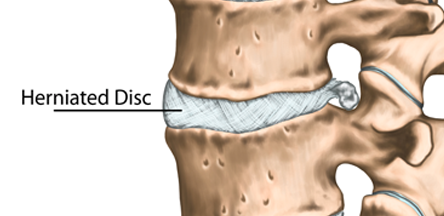 cervical-spine-condition-cervical-herniated-disc-illustration