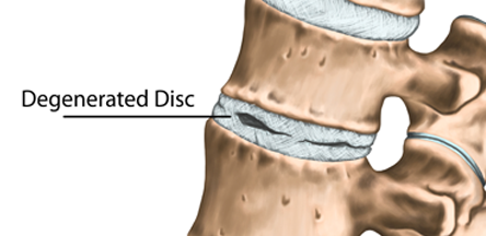 cervical-spine-degenerated-disc-condition-illustration