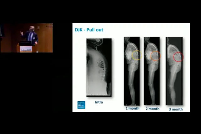 When Instrumentation Fails and the Spine Decompensates